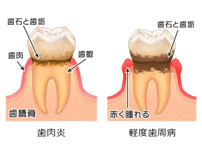 軽度の歯周病の治療