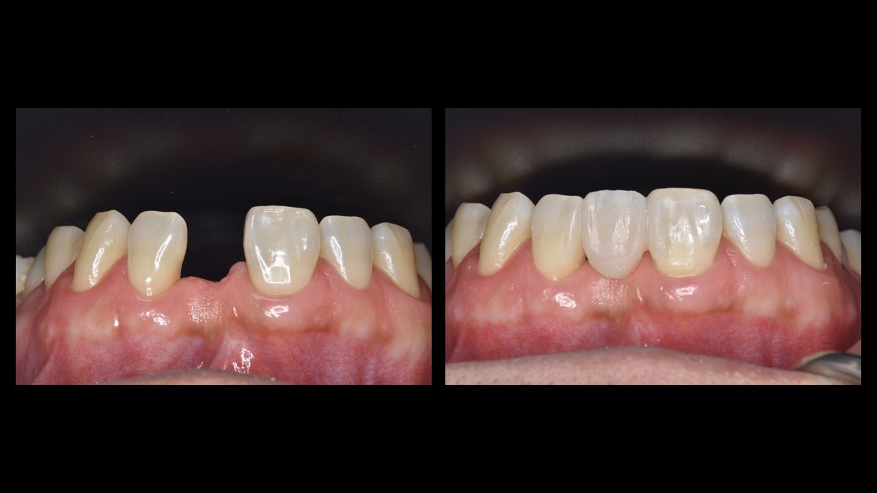 インプラント以外の選択肢(前歯)
