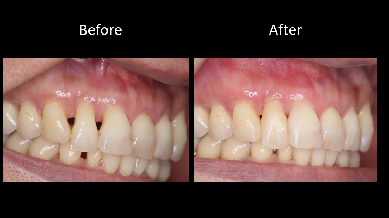前歯の黒い隙間が気になる方へ 