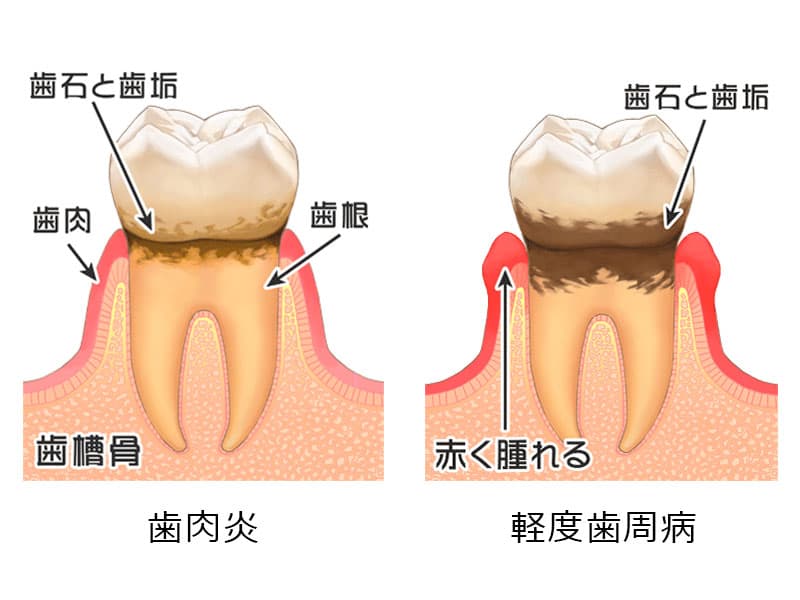 歯肉 炎 治療