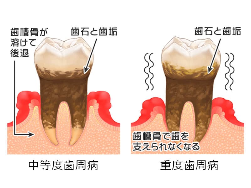 重度の歯周病の治療