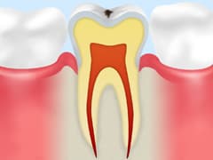 COごく初期の虫歯