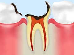 C4歯根に達した虫歯